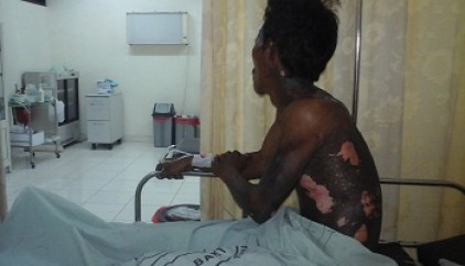  Disengat Listrik, Kulit Warga Bengkalis Melepuh